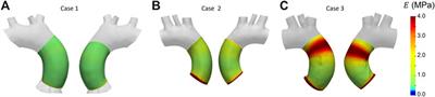 An image-based approach for the estimation of arterial local stiffness in vivo